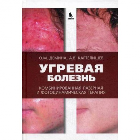 Медицинские энциклопедии и справочники, книга Угревая болезнь. Комбинированная лазерная и фотодинамическая терапия купить по скидке